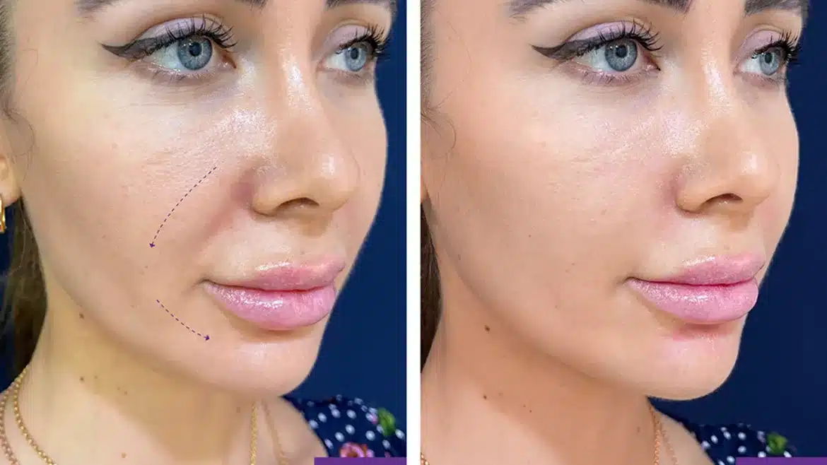 Nasolabial Fold Filler